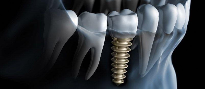 Ihr Zahnarzt in Fürth | Zahnimplantate sind mehr als nur Zahnersatz